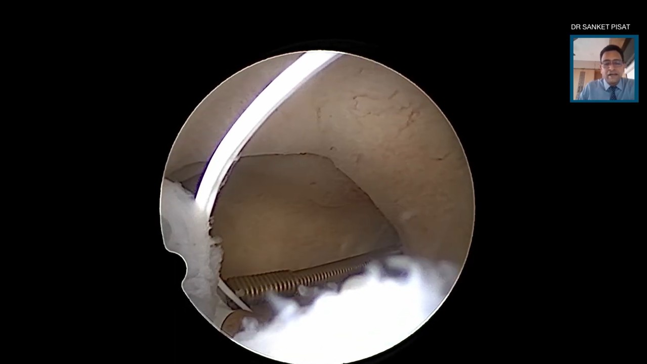 Hysteroscopic Copper T (IUCD) Removal (SS0037)