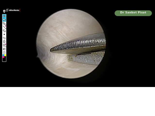 Hysteroscopy - Lat Metroplasty Failed IVF (NL0019)