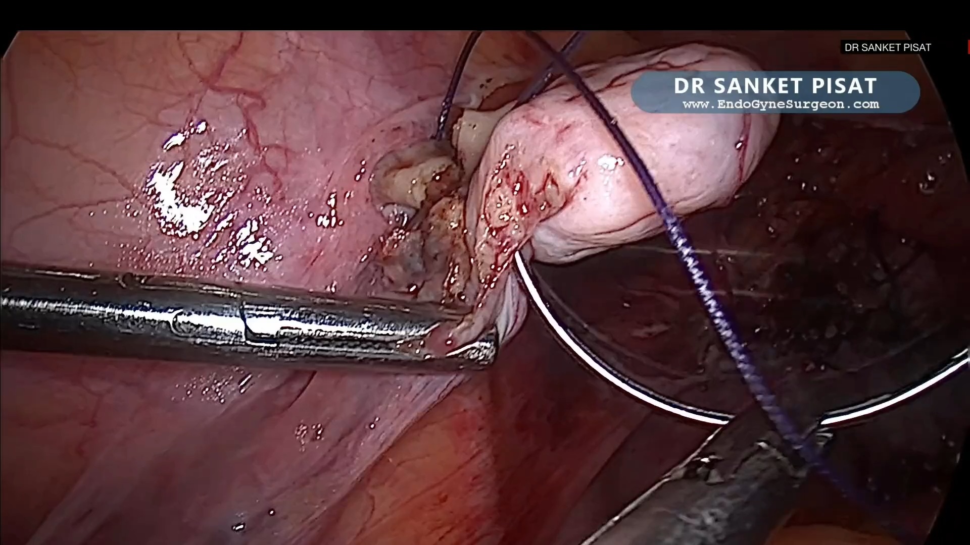 Prophylatic Ovarian Suspension For Ovarian Torsion After TLH (SS0108)