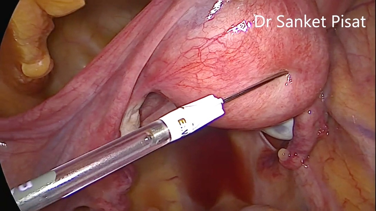 Laparoscopic Myomectomy For Lateral Wall Fibroid (NL0007)
