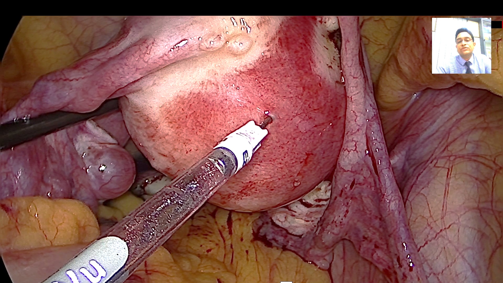 CL03 Multiple Myomas - Fertility Enhancing Surgery