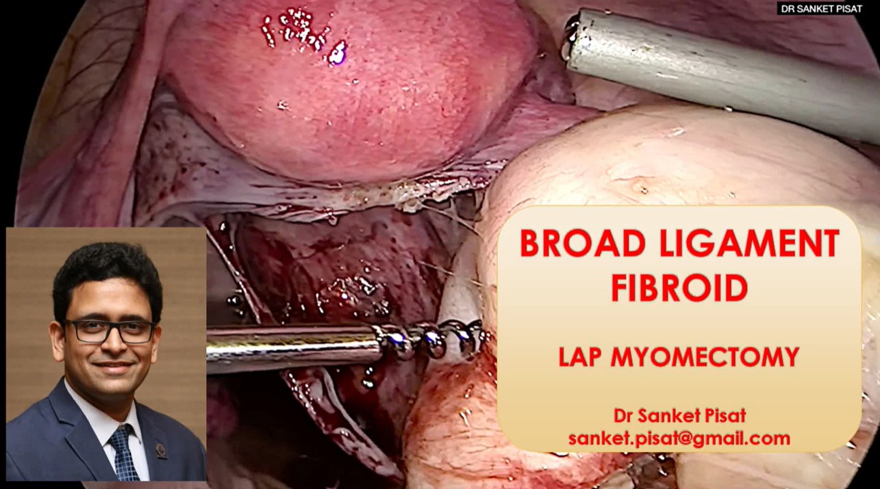 Lap Myomectomy Broad Ligament Fibroid (SS0030)