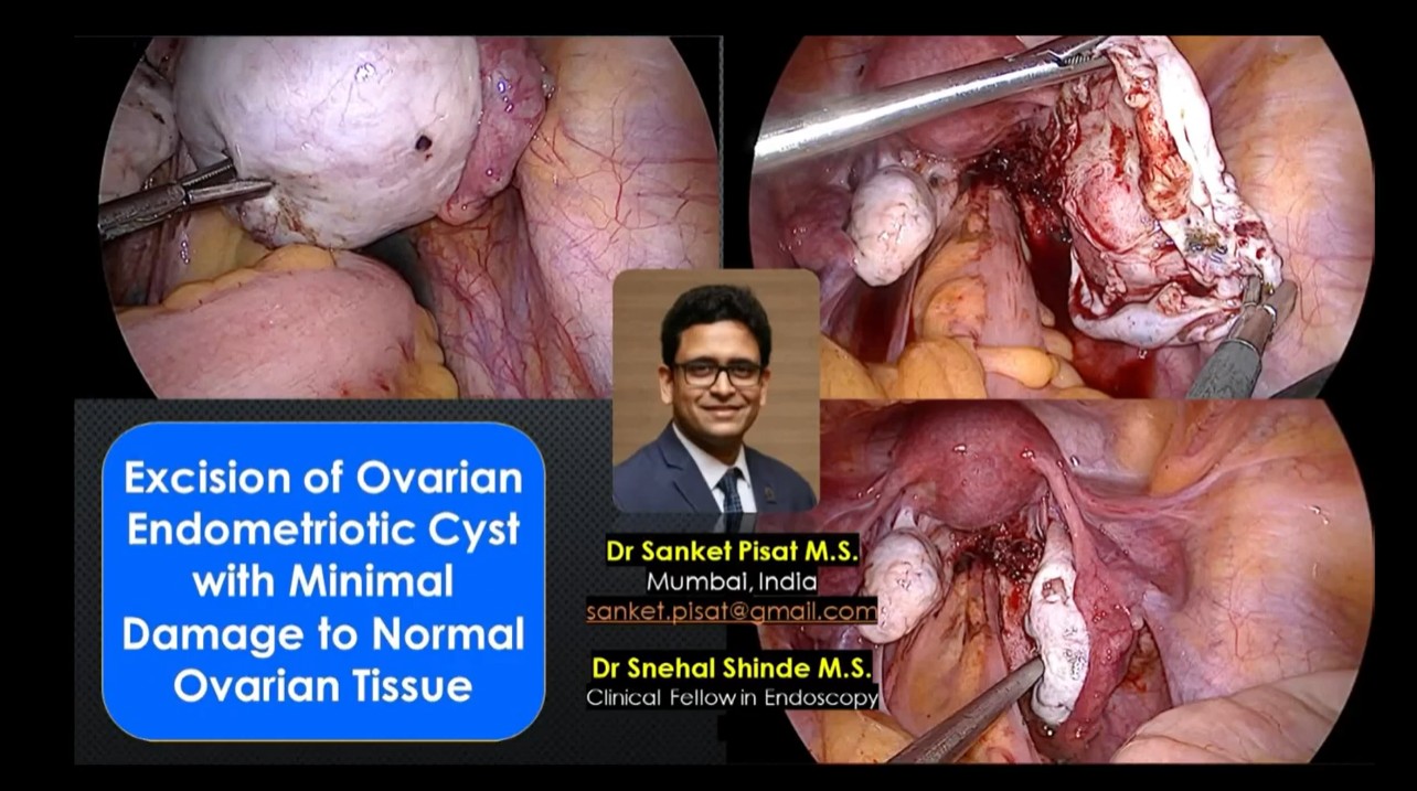 Laparoscopic Excision of Ovarian Endometriotic Cyst with Minimal Damage to Ovarian Tissue (SS0016)