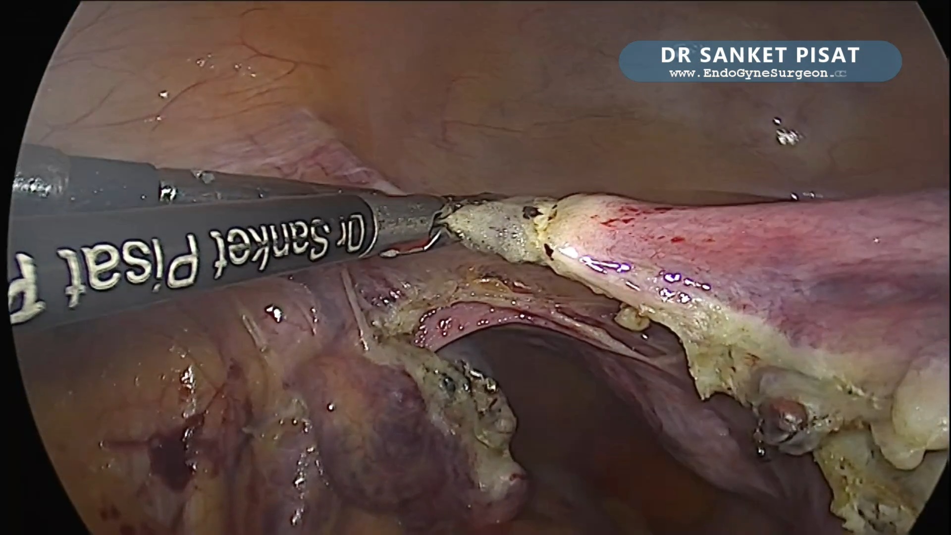 Simple TLH Bipolar Shearer (NL0071)