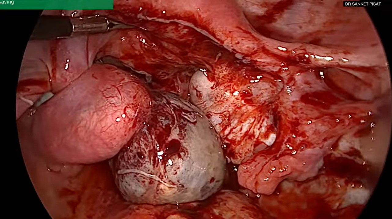 Laparoscopic Mangament of Ovarian Torsion (SS0019)