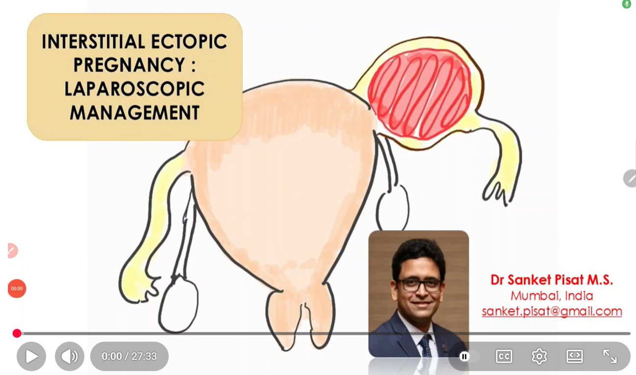 Laparoscopic Management of Interstitial/ Cornual Ectopic Pregnancy