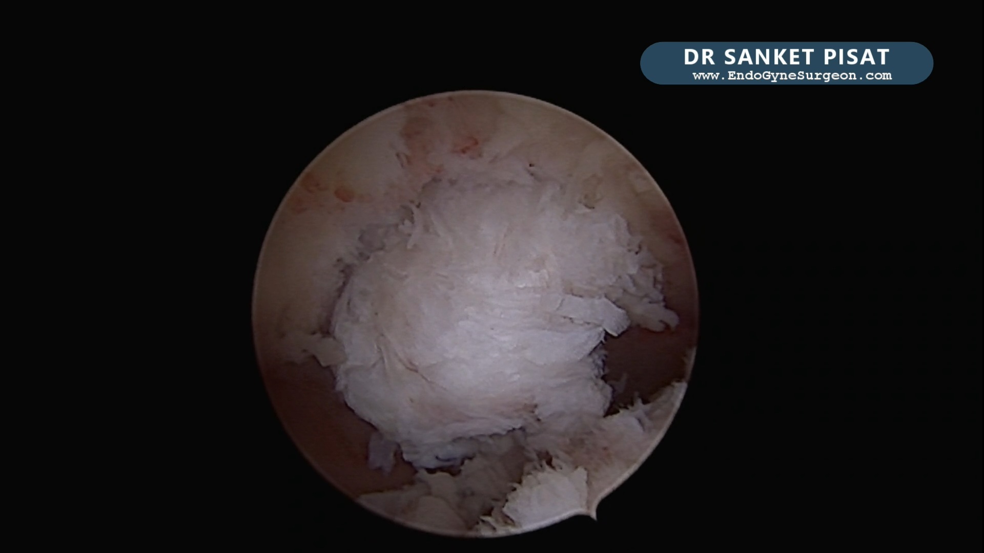 Complex Lap + Hyst Myomectomy - Multiple Myomas (Part 1 of 2) (NL0063A)