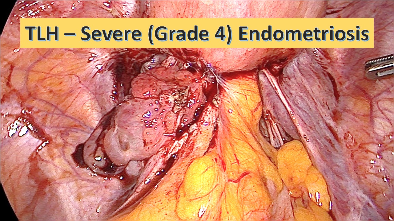 TLH - Severe (Grade 4) Endometriosis (hysterectomy) (NL0003)
