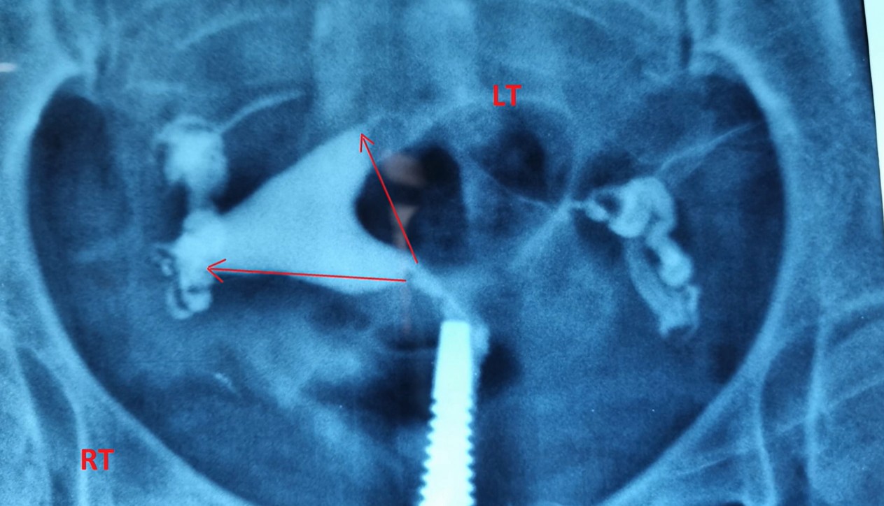 Hysteroscopic Lateral Metroplasty (SS0033)