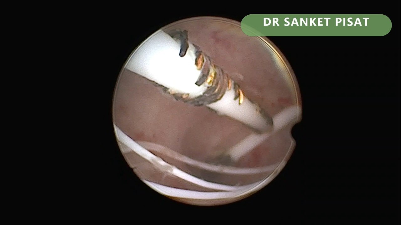 Hystero IUCD Removal By Vaginoscopy (NL0016)