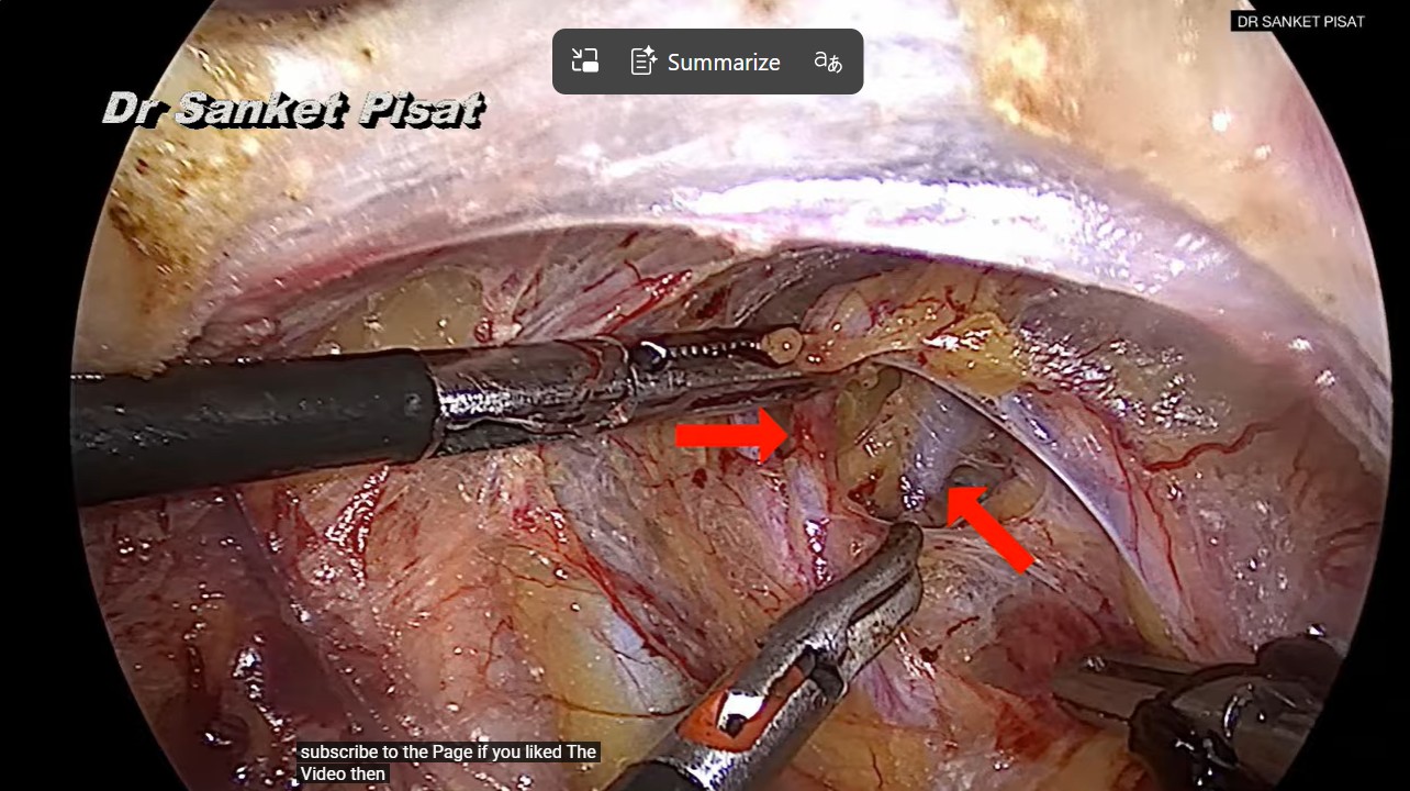 Laparoscopic Uterine Artery ligation