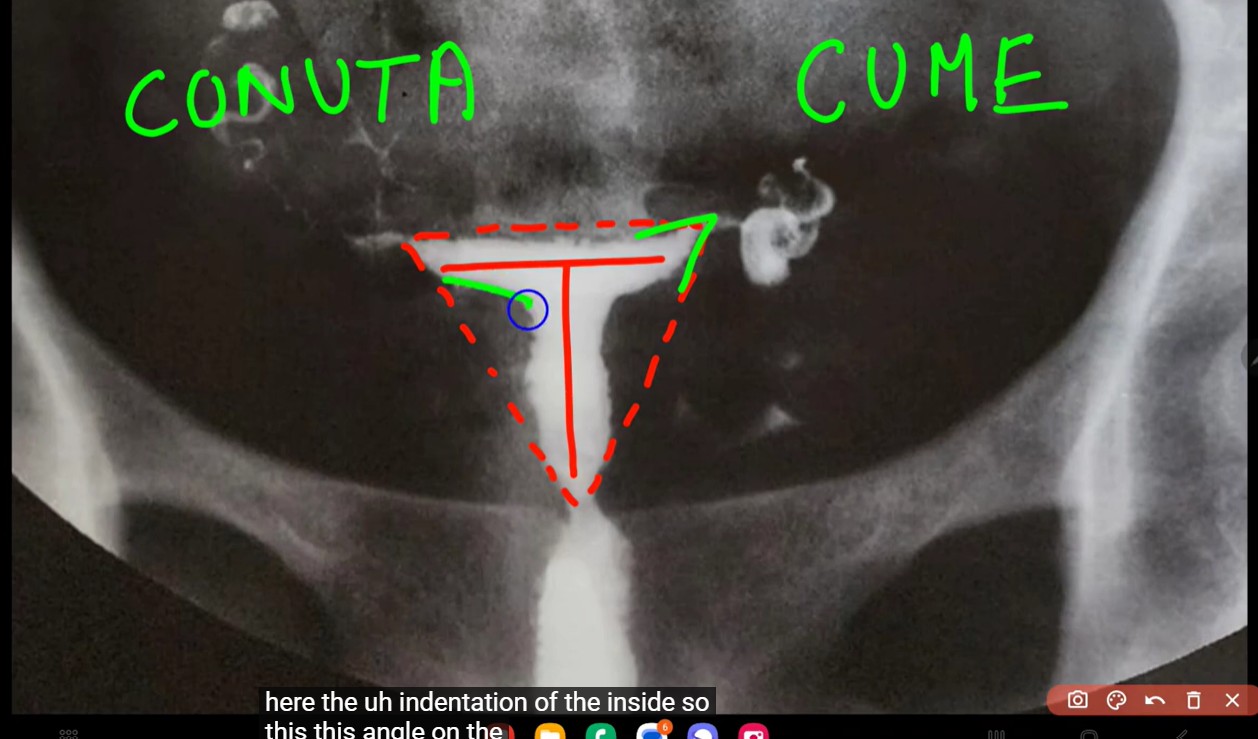 Hysteroscopic Lateral Metroplasty for Narrow T Shaped Uterus using Resectoscope