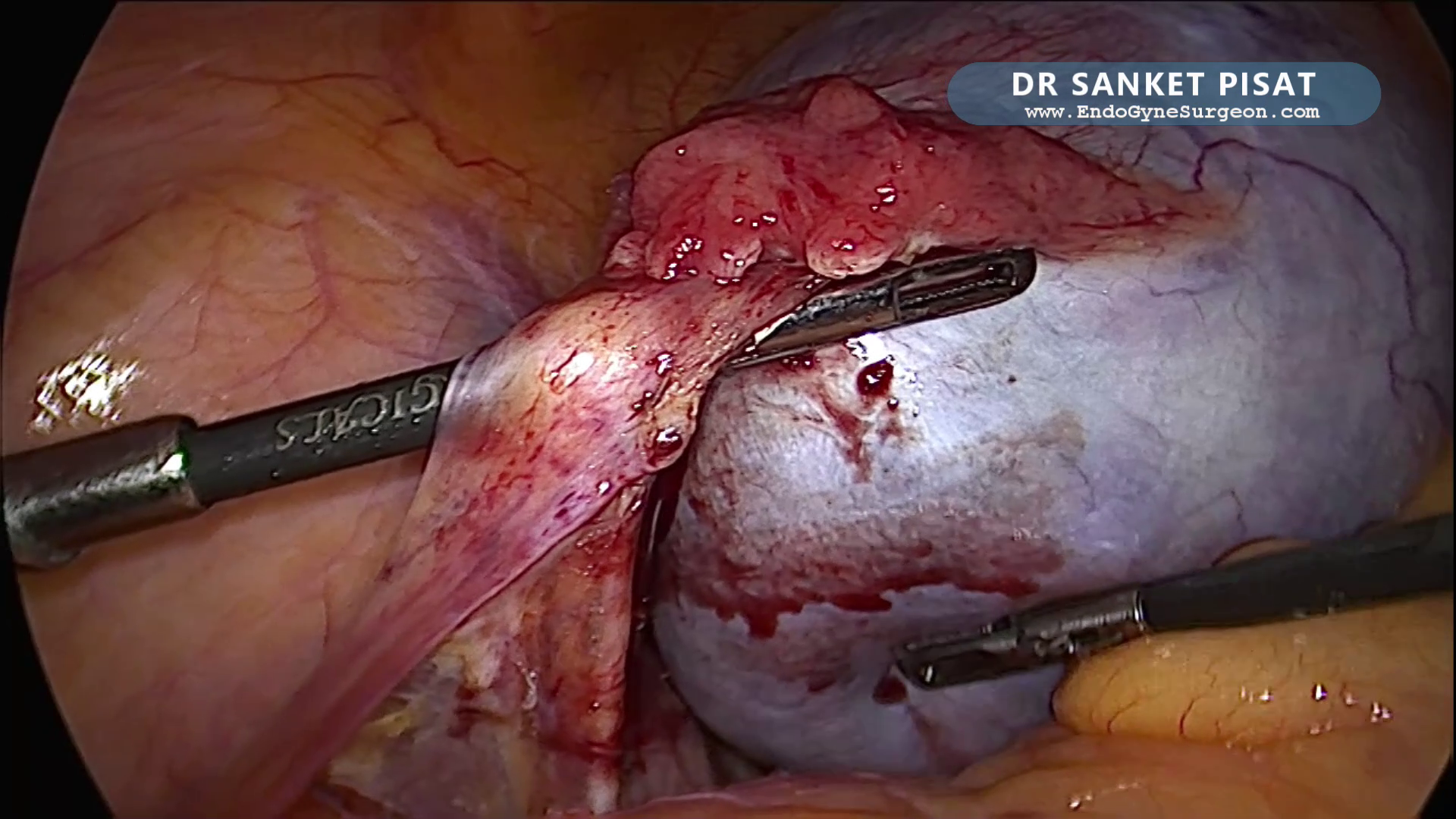 Lap Oophorectomy - Complex Ovarian Mucinous Cystadenoma