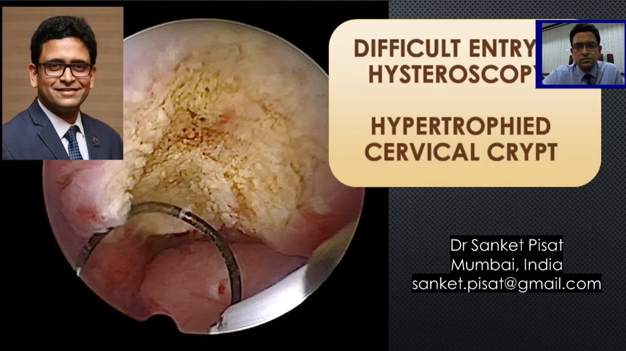 Difficult Hysteroscopy Entry - Hypertrophied Crypt (SS0038)
