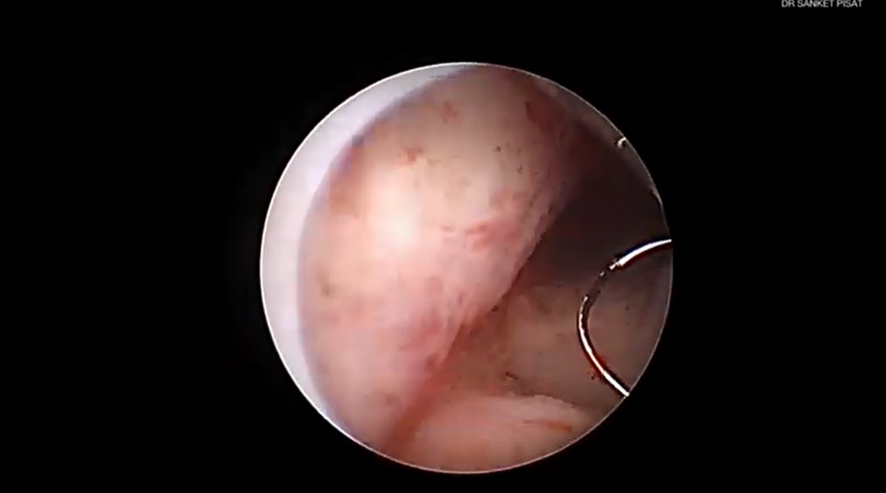 Hysteroscopic Fibroid Polyp Resection
