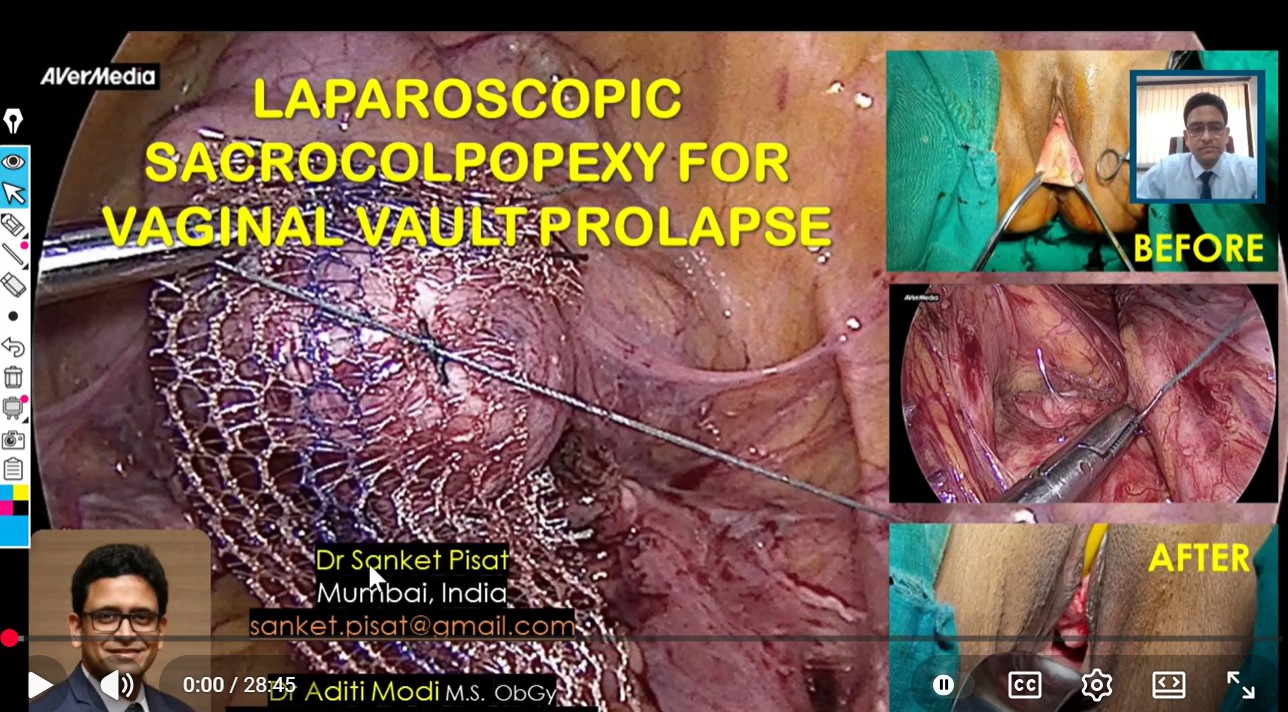 Laparoscopic Vault Prolapse Sacropexy (SS0044)
