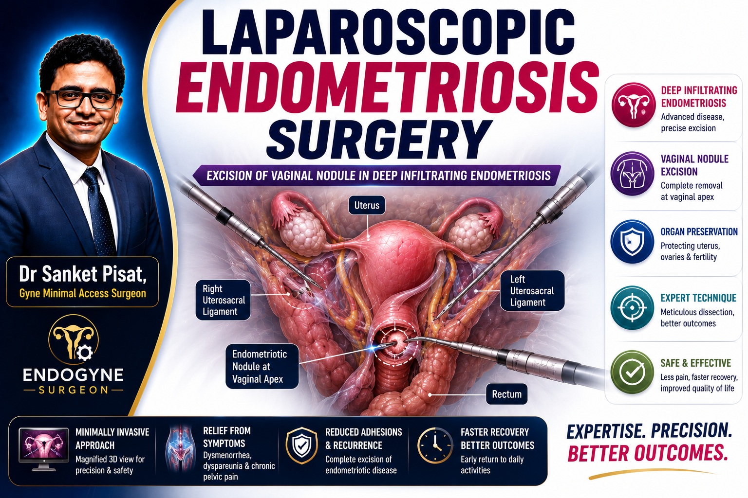 Laparoscopic Excision of vaginal Endometriotic Nodule in Deep Infiltrating Endometriosis (S0013)