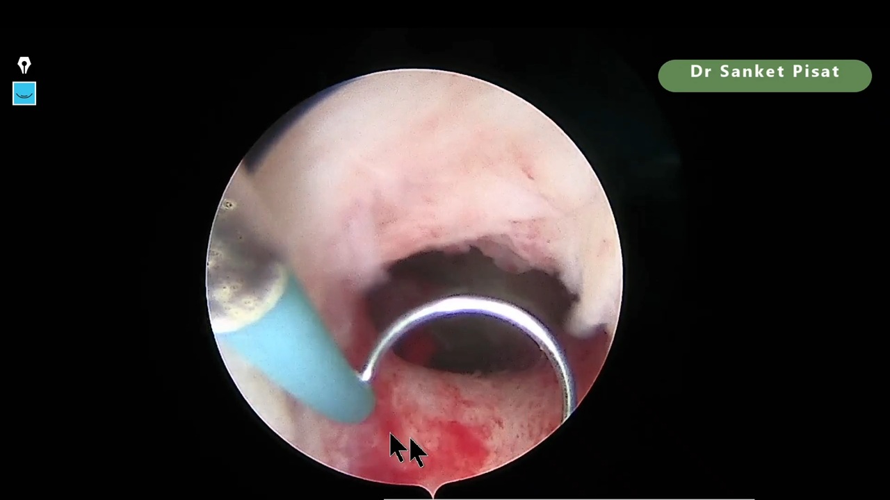 Hysteroscopy - Cervical Stenosis - Failed ET