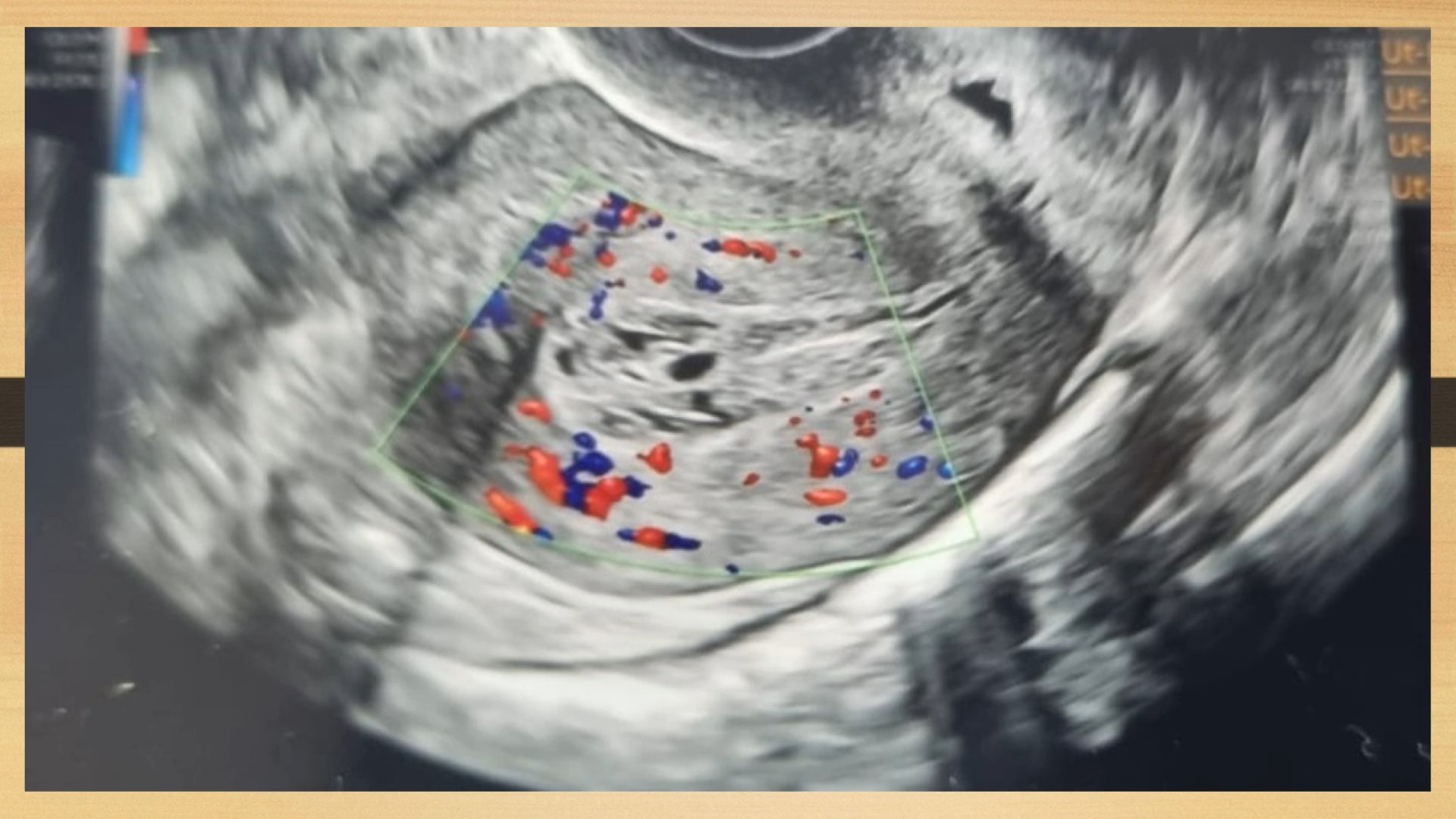 Hysteroscopic Curettage For RPOCs (NL0069)
