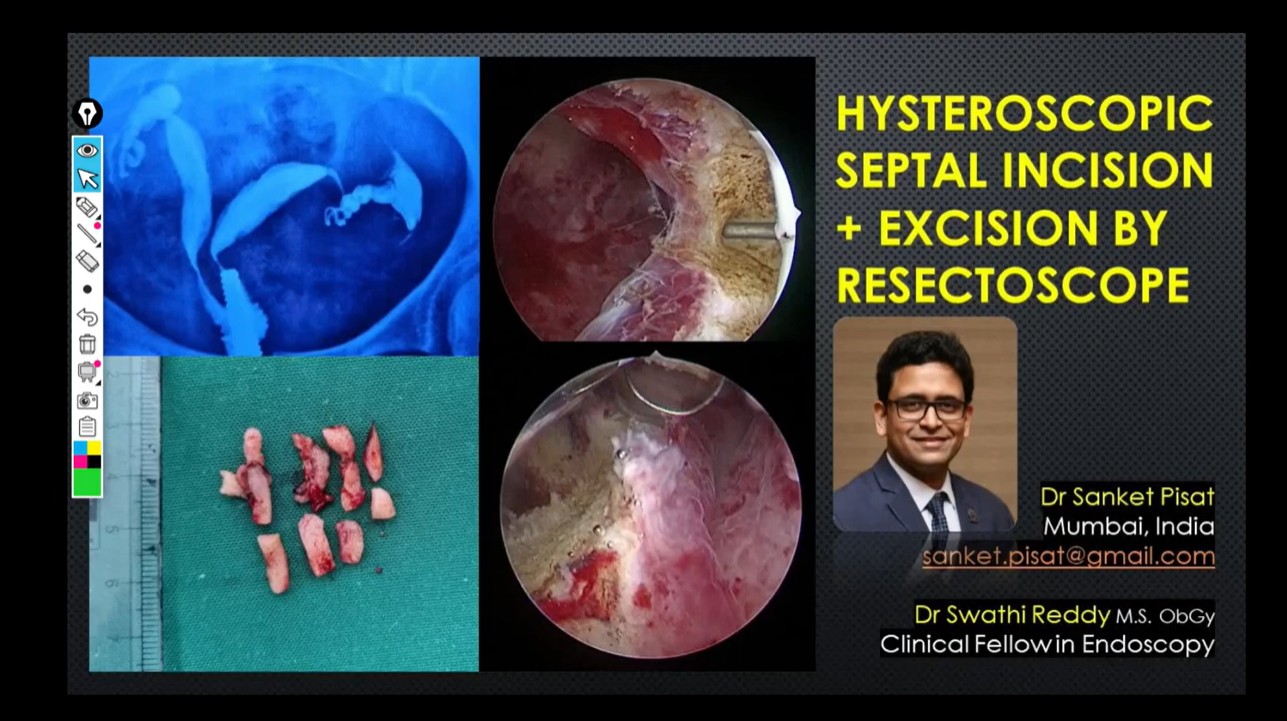 Hysteroscopic Septum Resection Bipolar Resectoscope (SS0067)