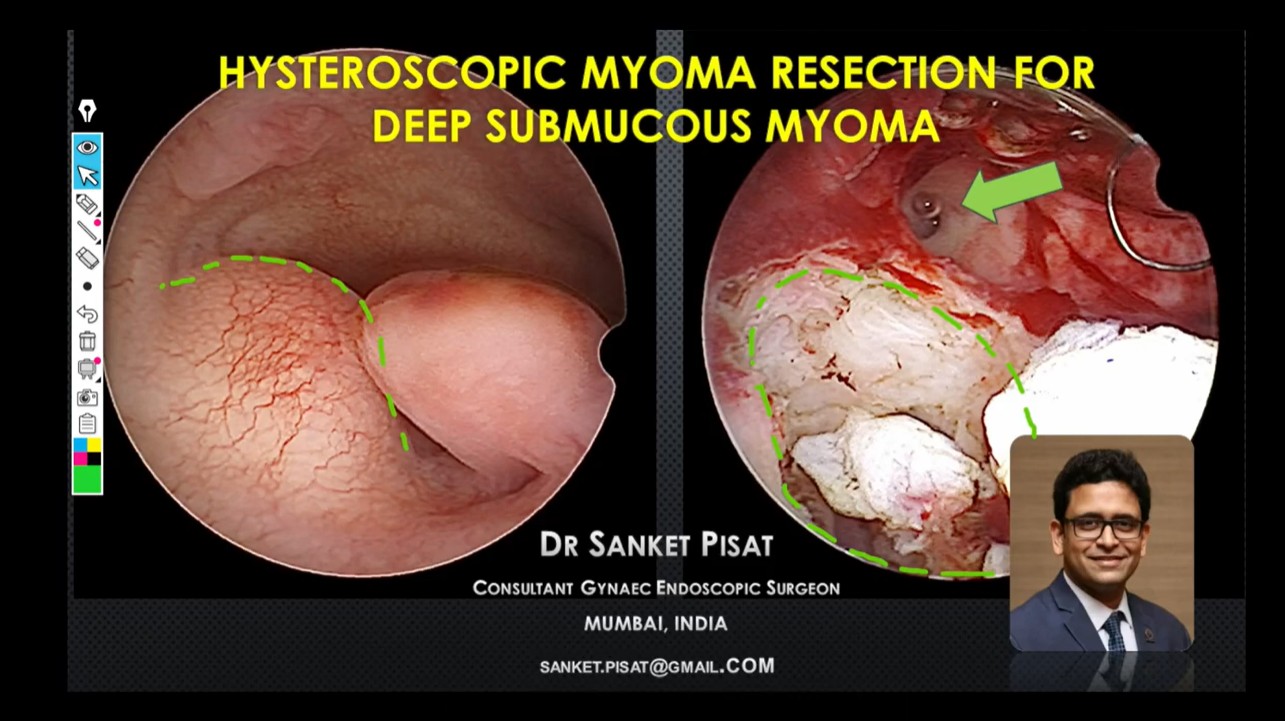 Hysteroscopic resection of deep submucous myoma (SS0009)
