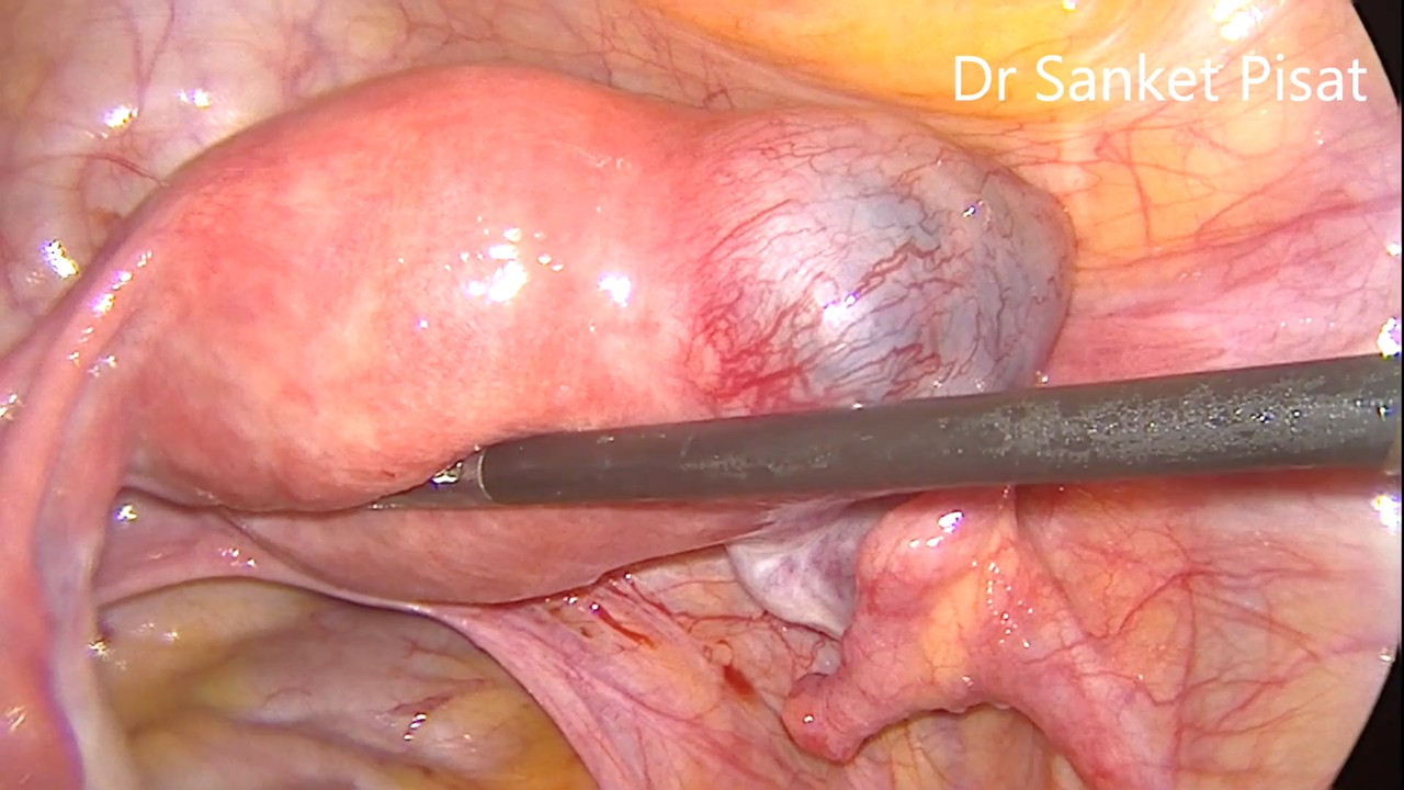 Laparoscopic Salpingectomy For Interstitial Ectopic Pregnancy (NL0010)