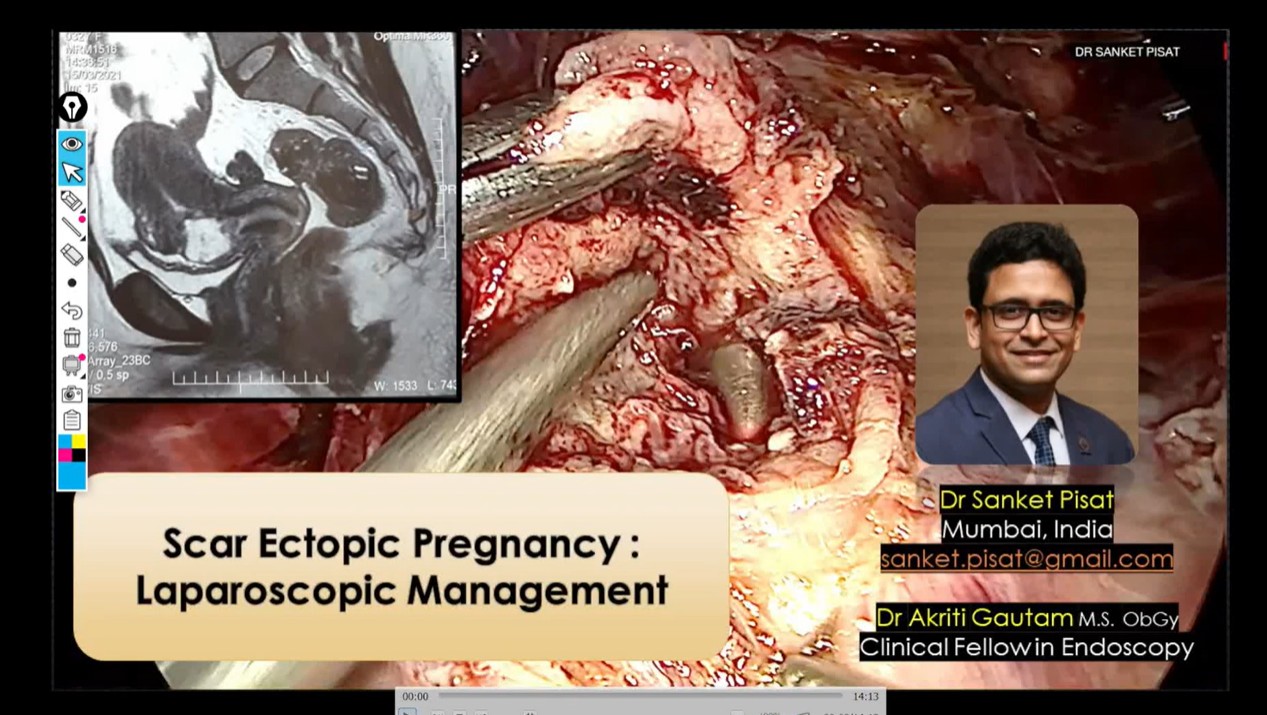 Laparoscopic Management of Scar Ectopic (SS0039)