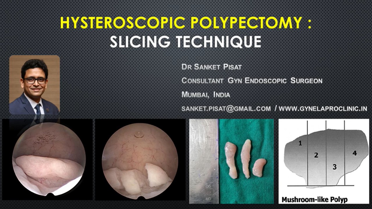 Hysteroscopic Polypectomy Slicing Technique & Submucous Fibroid